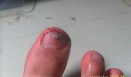 指甲断裂图片,图片解析与预防攻略